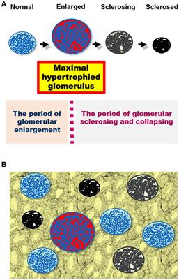 Glomerular hyperfiltration and hypertrophy: an evaluation of maximum values in pathological indicators to discriminate “diseased” from “normal”